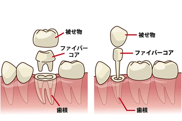 ファイバーコアポストイメージ