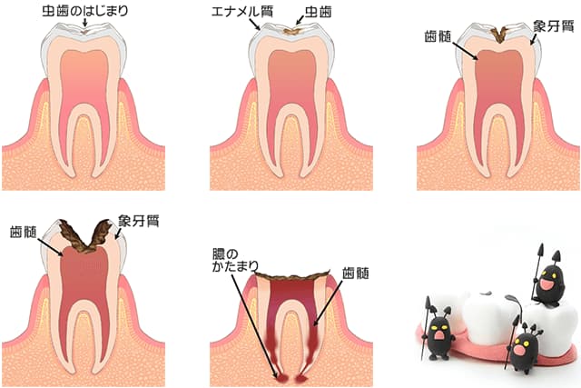 虫歯の進行イラスト