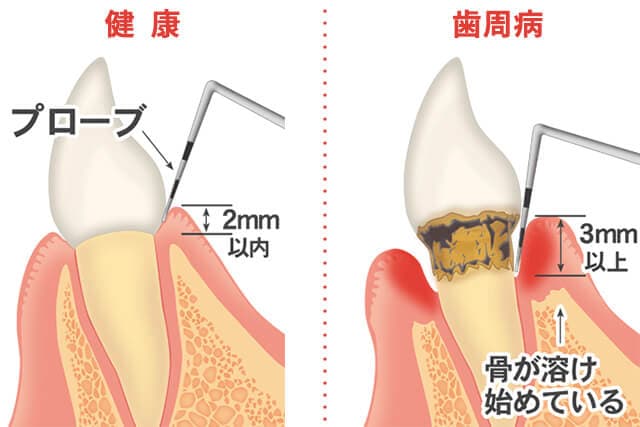 歯周組織の検査イメージ