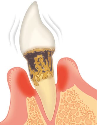 歯周病のイメージ