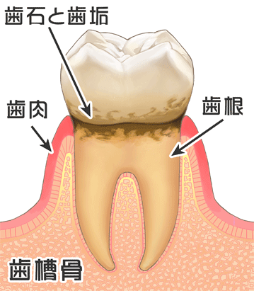歯肉炎