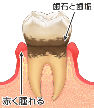 軽度の歯周炎