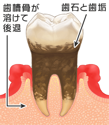 中等度の歯周炎